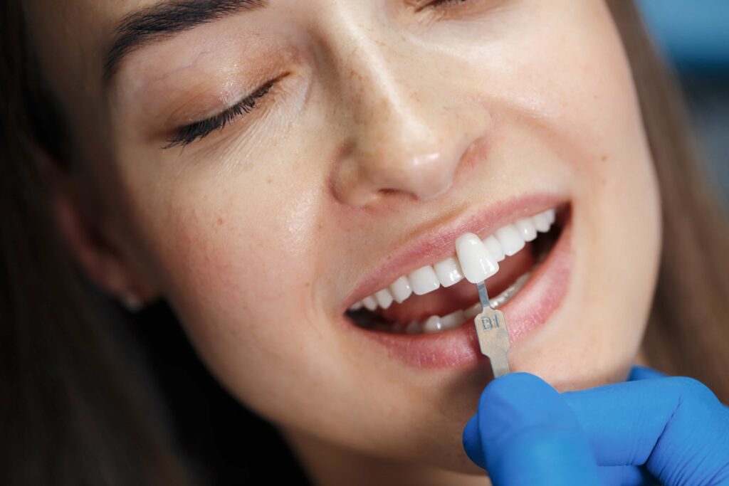 Faccette dentali Veneer Messina